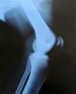 Avascular Necrosis (AVN) Treatment | Orthopedist | Arthritis Treatment | Arkansas