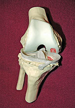 Post-Traumatic Arthritis Treatment Little Rock AR