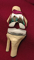 Post-Traumatic Arthritis Little Rock AR
