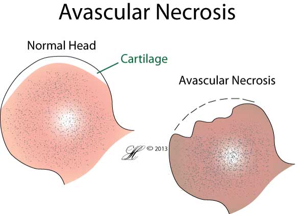 Avascular Necrosis (AVN) Little Rock, AR