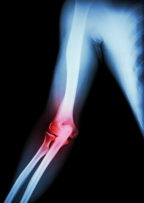 Inflammatory Arthritis Treatment | Orthopedist | Arthritis 