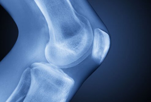 Osteoarthritis Little Rock